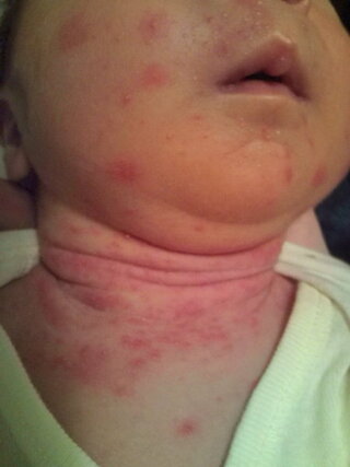 生後11日 赤ちゃんの湿疹などについて 教えて下さい まず気になる Yahoo 知恵袋