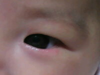 ６ヶ月の赤ちゃんの目の周りに湿疹 がでました 朝からなんとなくうっ Yahoo 知恵袋