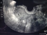 妊娠５週１日胎嚢の大きさについて妊娠５週１日に初診で胎嚢が小さくて 胎嚢かど Yahoo 知恵袋