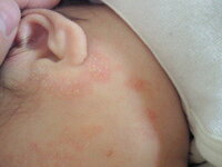 生後２ヶ月の息子の湿疹についてですただれてる ような感じにも見えますカサカサ Yahoo 知恵袋