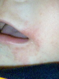 離乳食を始めてからなのですが 夕方くらいから口の周りに赤い湿疹 Yahoo 知恵袋