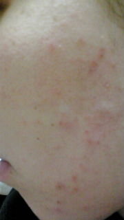 助けてくださいこの３ヶ月ほど月に一度フェイスライン 右側 が異様にかゆくなり Yahoo 知恵袋