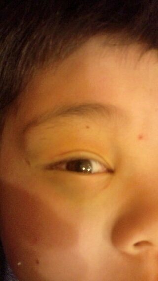 小学校4年の息子が友達と正面衝突をして目の上を打撲しました 最初は目の上が蚊 Yahoo 知恵袋