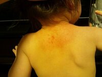 オロナインって日焼け止めになるんですか オロナインって日焼け止めになる Yahoo 知恵袋