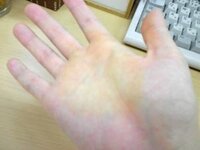 手のひらの一部が黄色になっていました 何かの病気でしょうか Yahoo 知恵袋