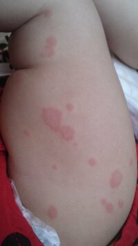 赤ちゃんの湿疹について9ヶ月になったばかりの娘の手足に赤い斑点がで Yahoo 知恵袋