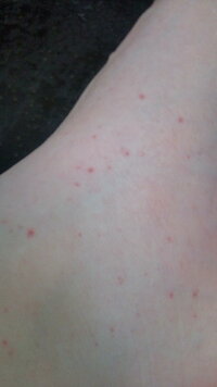 かゆく 赤い ない 太もも 斑点 顔・腕・足・手・お腹・背中などのかゆくない湿疹の原因は？