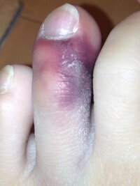 足の指を打撲しました 座っていれば痛くはないのですが 歩くと痛みが Yahoo 知恵袋