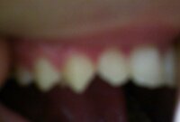 前歯の隣の歯３本ほどが尖っています ぼやけてて見にくいですが 写真 Yahoo 知恵袋