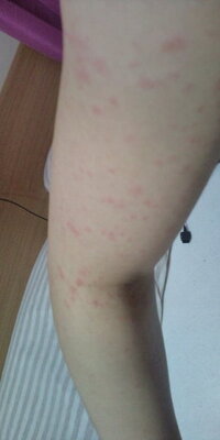 昨晩 横になってたら急に全身写真のような赤い湿疹が出ました 今日内科で見ても Yahoo 知恵袋