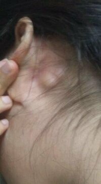しこり たい 耳 か の 後ろ 耳の後ろの腫れ：医師が考える原因と受診の目安｜症状辞典
