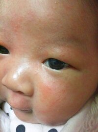 鼻の頭に白いブツブツ ２歳の娘がいます 生まれたときに鼻 Yahoo 知恵袋