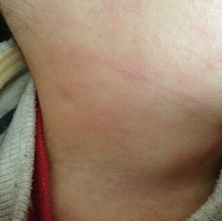 乳児湿疹でしょうか 8ヶ月の子供ですが 比較的生まれた時から4ヶ月く Yahoo 知恵袋