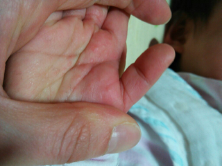 赤ちゃんの手のひらに湿疹ができました もうすぐ１歳の赤ちゃんです 手のひらに赤 Yahoo 知恵袋