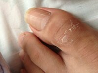 黒ずみ 指 の 関節 指の関節痛として考えられる７つの原因｜ヘルモア