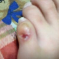 先日 3月29日に慣れない靴を履き靴擦れをおこしました 水ぶくれができたので Yahoo 知恵袋