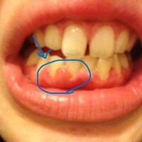 歯茎の一部だけの腫れについて 昨日から歯茎の一部が腫れて痛いです 昨日の Yahoo 知恵袋
