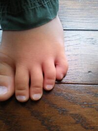 子どもの足の小指が曲がっています 両足とも小指がくの字にまがっ Yahoo 知恵袋
