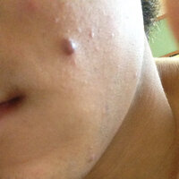 ホクロに ニキビが出来ました 少し赤くなっていて 熱くなっています 場所は Yahoo 知恵袋