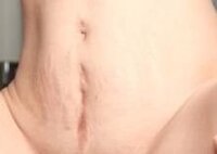 このヘソの下の縦の傷痕は 帝王切開をした跡でしょうか 帝王切開の可能性あ Yahoo 知恵袋