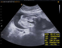 妊娠24週 7ヶ月 エコー写真での性別診断お願いします 先日7ヵ月健診に Yahoo 知恵袋