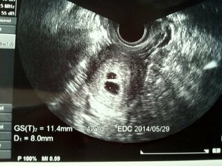 胎嚢エコー写真これは双子でしょうか 次の検診までいてもたってもいられ Yahoo 知恵袋