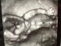 妊娠14週の妊婦です 今日検診でエコー写真とったのですが 先生はとく Yahoo 知恵袋