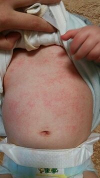 湿疹 画像あり 生後５ヶ月の子供のお腹と背中が赤くぶつぶつしてカサカサし Yahoo 知恵袋