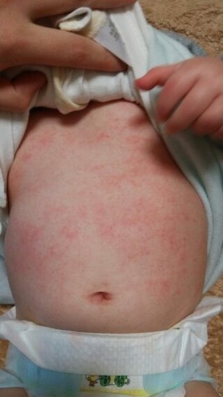 湿疹 画像あり 生後5ヶ月の子供のお腹と背中が赤くぶつぶつしてカサカサし Yahoo 知恵袋 湿疹 画像あり 生後5ヶ月の子供のお腹と背中が赤くぶつぶつしてカサカサし Yahoo 知恵袋