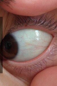 画像あり これは新生血管でしょうか よく寝ても 体調がいい時でも コン Yahoo 知恵袋