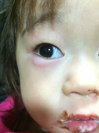急です 2歳の娘ですが急に涙袋が腫れました これは何でしょうか 眼科でしょうか Yahoo 知恵袋