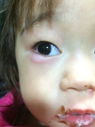 子供 まぶた の 腫れ まぶたの腫れ