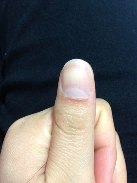甘皮の下の黒ずみはどうしたら綺麗になりますか 不適切な甘皮のお Yahoo 知恵袋