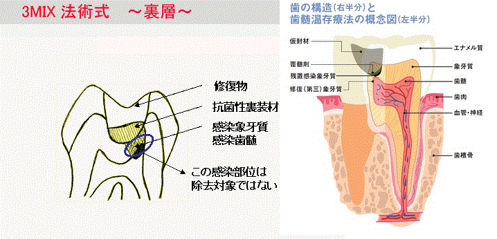 覆髄と裏層】 - 覆髄と裏層の違いってなんですか。。。？調べればすぐ分かるこ... - Yahoo!知恵袋