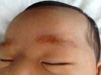 乳児湿疹について 生後一ヶ月の息子がいます 眉毛のところが 黄色いか Yahoo 知恵袋
