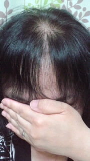 当方かなりの薄毛です 40代女性 くせ毛もかなりありますし 白髪もかなりあ Yahoo 知恵袋