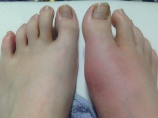 むくみなのか 左足なんともなく右足親指裏足が痛く何処にぶつけた覚えが Yahoo 知恵袋