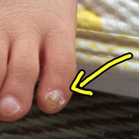 子どもの爪について 子どもの足の小指の爪がなんだかおかしいような気がしま Yahoo 知恵袋
