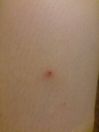 ダニでしょうか 赤いプツプツが左足と腰の左側にたくさんあります 痒い Yahoo 知恵袋