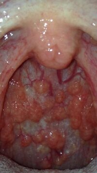 の もの でき 喉 赤い 奥 のどにできものが！そのままでは危ない場合も