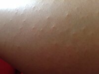 子供の腕に出来る無色の発疹について 画像注意 7歳の息子の腕に出来 Yahoo 知恵袋