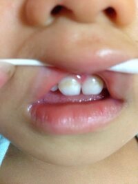 子どもの前歯が茶色くなっているのですが 虫歯でしょうか 来週 歯医者さん Yahoo 知恵袋