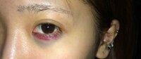 今日涙袋にヒアルロン酸を0.1cc入れてきました。 右目は大丈夫なのですが、左目だけ施術する際に毛細血管に当たってしまったらしく内出血が酷いです。(写真のように目の淵と目の下の青くなってるのも内出血です)

病院から帰宅したら余計痣が酷くなってきました。

医師、看護師さんには1週間ほどでよくなる、冷やすと内出血の消えが早くなると言われました。

まだ当日なので仕方ないと思いますが、数日経つ...