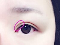 元は両目重い奥二重なのですが 片目だけに瞼に小さいできもの ができて Yahoo 知恵袋