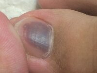 爪の色が変色 きつい靴をはいて長時間歩いていたら爪全体が紫色にな Yahoo 知恵袋