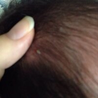 産後二週間程度の娘の頭に白い膿のような かさぶた ができています 一 Yahoo 知恵袋