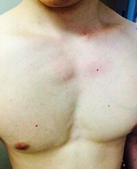 これはしこりなのでしょうか 写真から見て左胸の上あたりです Yahoo 知恵袋