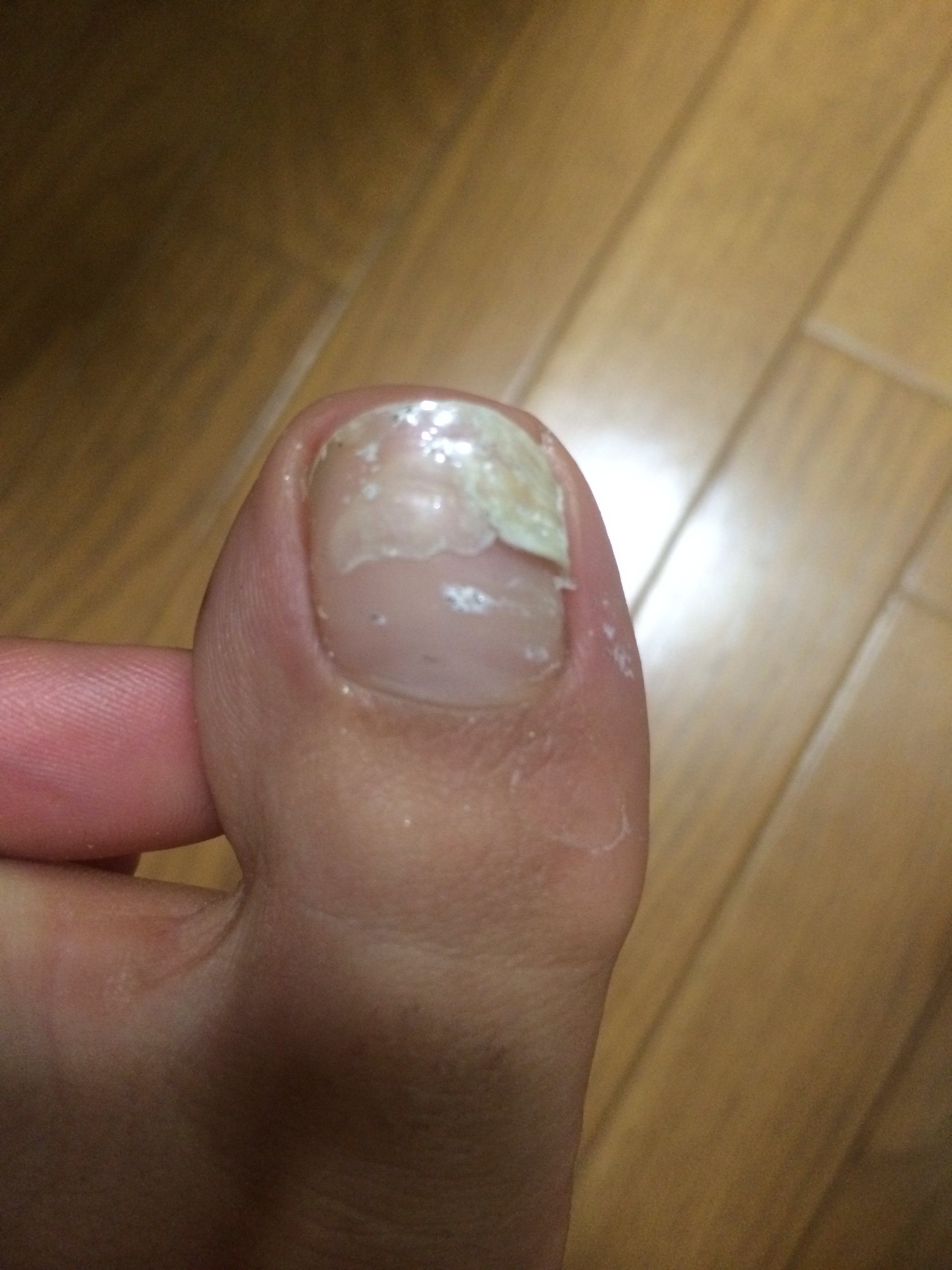 足の爪が割れる 親指 処置