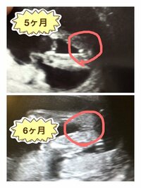 エコー写真で質問です 6ヶ月の妊婦です 先月は男の子かなぁ と言われ 今月は Yahoo 知恵袋