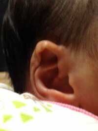 この写真の耳を見てダウン症の可能性はありますか 産まれた時は 左右どちらも同じ Yahoo 知恵袋